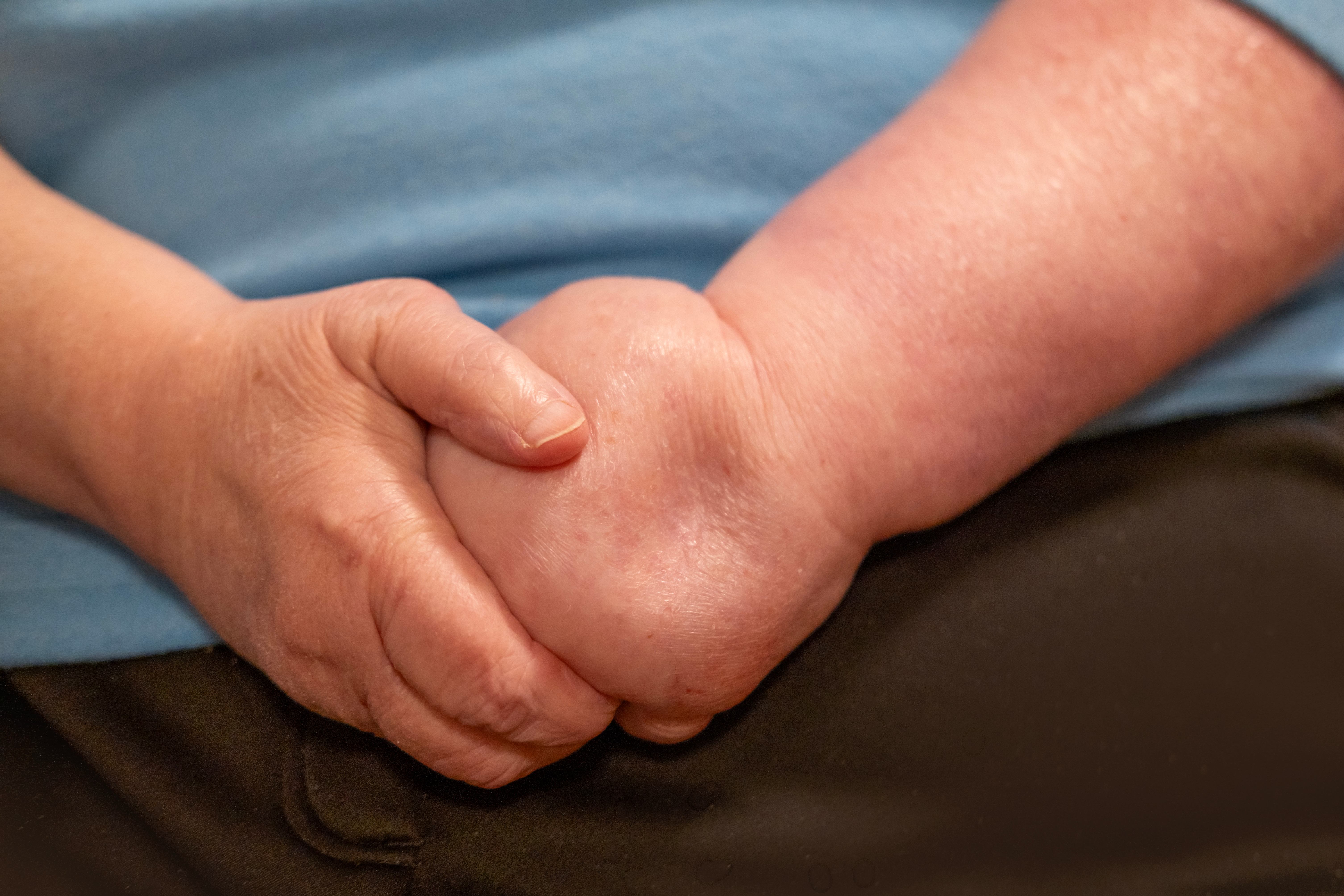 Gezocht: mensen met lymfoedeem na borstkanker voor deelname aan de LYMPH-Trial